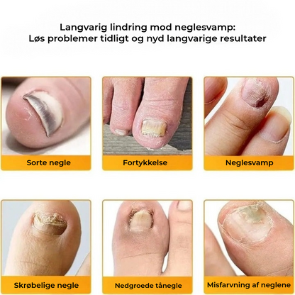 FungalPatch - Antibakteriel Svampedræbende Plaster og Negleplejepakke